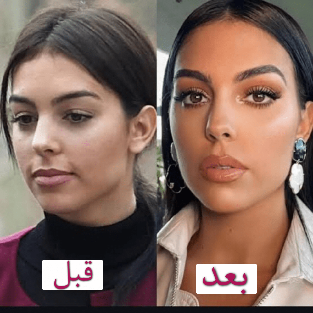 جورجینا رودریگز قبل از عمل و بعد از عمل